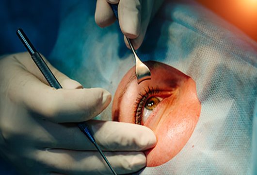 Op. Dr. Suphi Alolo, katarakt cerrahisi sırasında akıllı göz içi mercek uyguluyor, Çorlu, Tekirdağ.