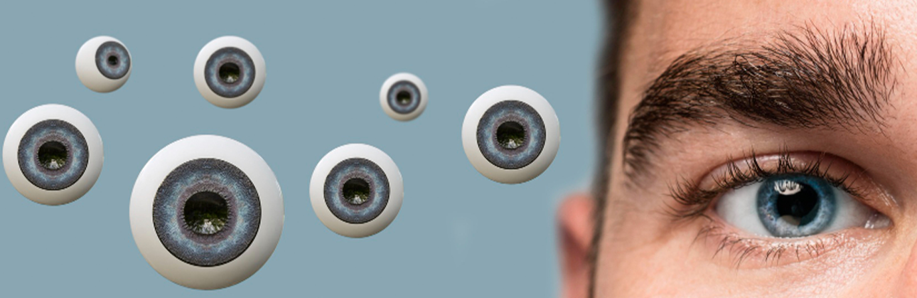 Göz tansiyonunun optik sinir üzerinde nasıl hasar oluşturduğunu ve göz içi basıncının arttığı yapısal modeli gösteren glokom görseli.